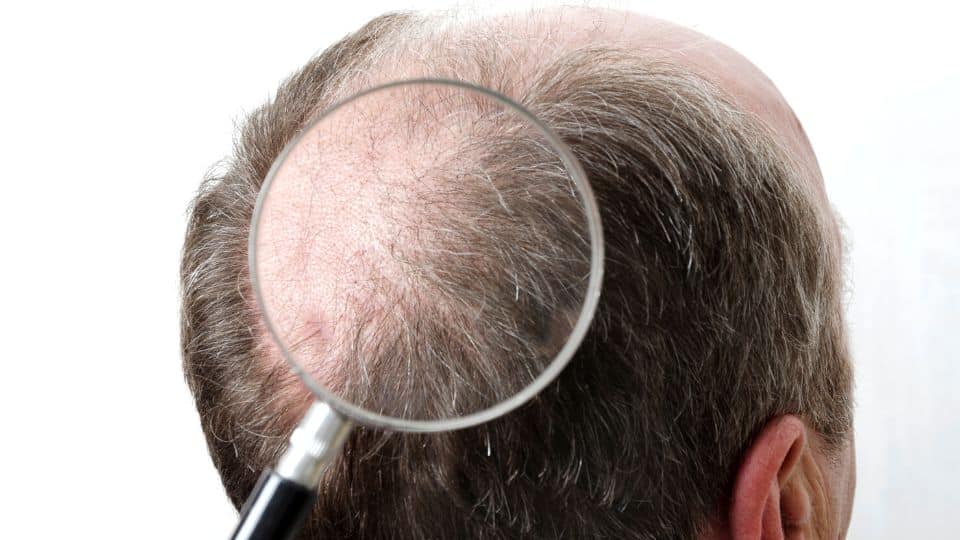 כמה עולה השתלת שיער בטורקיה?
